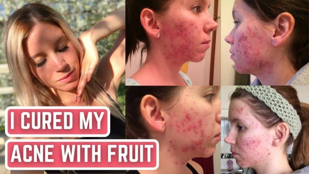 Before/after acne transformation photos showing skin improvement, with text overlay "I CURED MY ACNE WITH FRUIT"