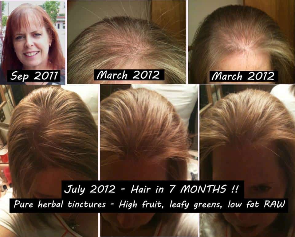 drmt-testimonial-hair-regrowth-i